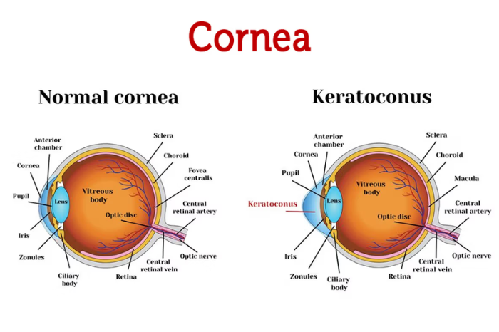 Keratoconus: Causes