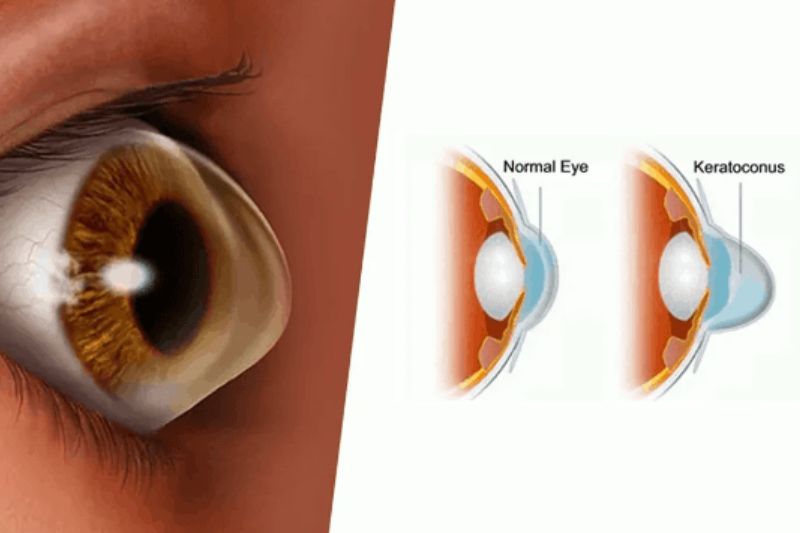 Keratoconus